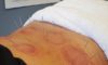 Sports Recovery Acupuncture: Unlock 6 Key Advantages