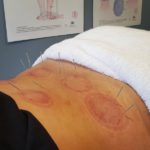 Sports Recovery Acupuncture: Unlock 6 Key Advantages