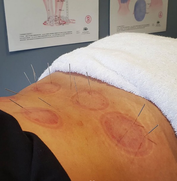 Sports Recovery Acupuncture: Unlock 6 Key Advantages
