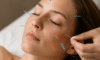 Cosmetic Acupuncture: Important Drawbacks to Bear in Mind