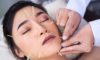 Cosmetic Acupuncture: Important Drawbacks to Note